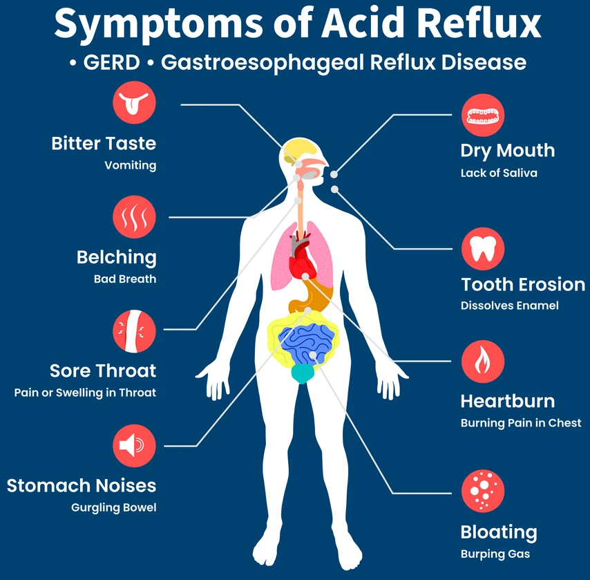 Symptoms of Acid Reflux, GERD, gastroesophageal reflux disease, Heartburn, chronic Acidity, Gastric disease, stomach problem. Feeling pain bloating abdomen reflux high acid illustration flat